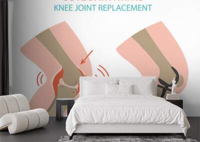 Arthritis, osteoarthritis medical infographic design. Joint replacement, implantant. Wall mural