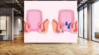 piles. hemorrhoidal disease. comparison and differences between healthy rectum and part of a large intestine with internal and external hemorrhoids, Pectinate line and Rectal bleeding Wall mural