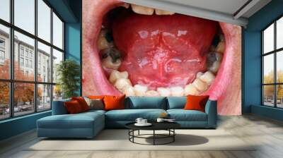 Tartar and amalgam fillings Wall mural