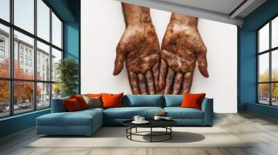 Male hands affected by blistering rash because of monkeypox or other viral infection on white background Wall mural