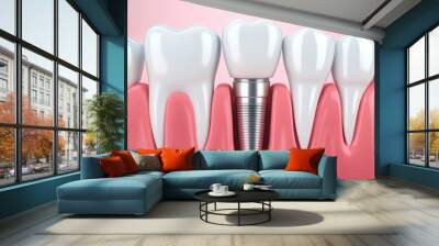 Dental Implants Illustration With Metal Crown And Post Wall mural