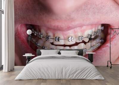 Metal orthodontic braces on crooked ugly teeth close-up. Ugly smile. Dental concept, medicinal alignment of teeth, brackets orthodontist Wall mural