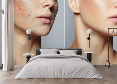 Teenage girl before and after acne treatment Skin care concept. Acne treatment in a cosmetology clinic Wall mural