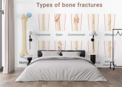 Types of femoral shaft bone fracture medical scheme infographic isometric vector illustration Wall mural