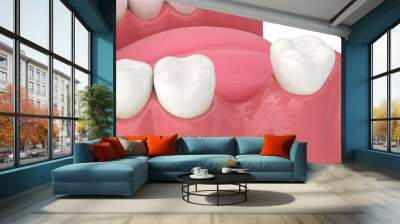 3d render of jaw bone recession after loosing tooth Wall mural