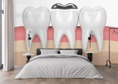 3d render of teeth with dental onlay amalgam filling Wall mural