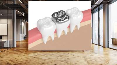 3d render of teeth with dental onlay amalgam filling Wall mural