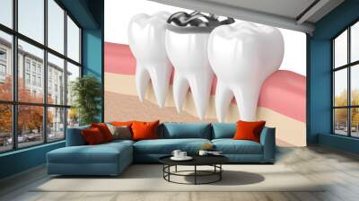 3d render of teeth with dental onlay amalgam filling Wall mural