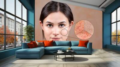 A gorgeous brunette girl poses for a portrait against a neutral background, a magnified circle shows areas of problematic skin in young adults, with herpes simplex, superficial blood vessels  Wall mural