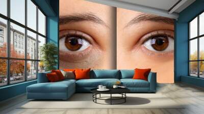 A macro view on the eye of a young lady. Showing before and after suffering from dark circles beneath the eye. Bruising is seen on the left and flawless complexion on the right. Wall mural