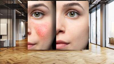 Collage comparing healthy skin and face suffering rosacea, visible blood vessels and capillaries. Caucasian woman face closeup. Medicine and healthcare concept. Wall mural