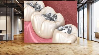 Amalgam restoration. Medically accurate 3D animation of dental concept Wall mural