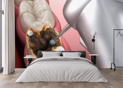 Caries removing process. Medically accurate tooth 3D illustration. Wall mural