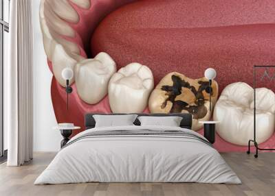 Caries removing process. Medically accurate tooth 3D illustration. Wall mural