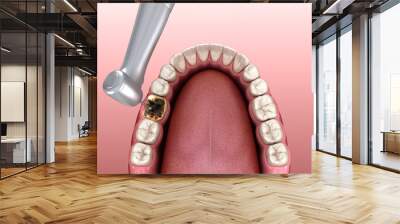 Caries removing process. Medically accurate tooth 3D illustration. Wall mural