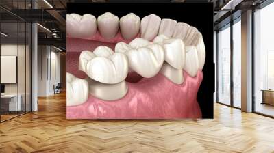 Dental bridge of 3 teeth over molar and premolar. Medically accurate 3D illustration of human teeth treatment Wall mural