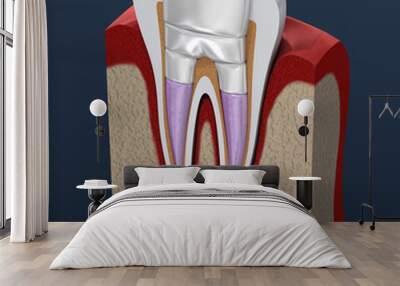 Dental fillings procedure diagramm . 3D illustration Wall mural