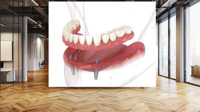 Mandibular removable prosthesis All on 2 system supported by implants with ball attachments. Medically accurate dental 3D illustration Wall mural