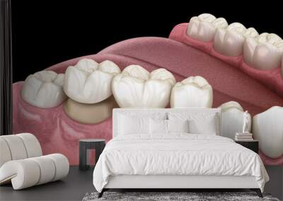 Molar and premolar tooth and dental bridge placement. Medically accurate 3D illustration Wall mural