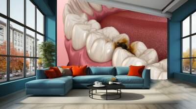 Molar teeth damaged by caries. Medically accurate tooth 3D illustration. Wall mural