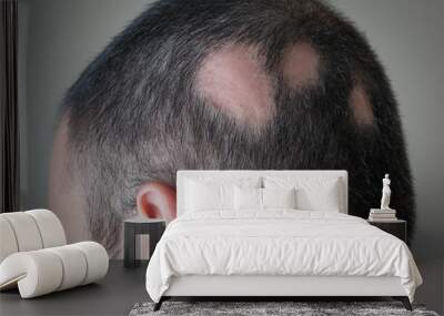 Alopecia Aerata - Spot Baldness Wall mural