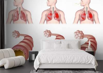 Anatomy of asthma, unlabeled.  Wall mural