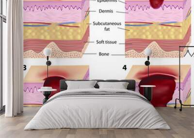 Stages of pressure sores Wall mural