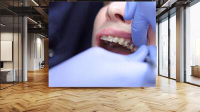 Ceramic braces and metal braces on the patient's teeth. Two types of braces on the teeth.Correction of bite and tooth growth. The work of an orthodontist. Modern dentistry. Wall mural