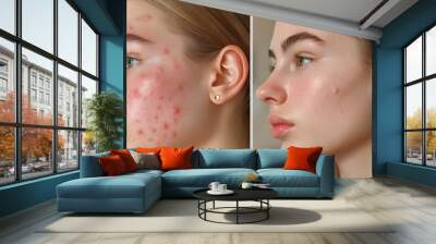 Close-up transformation of a young adult using a natural acne-clearing routine Before image shows red, inflamed skin; after image displays smooth, even tone Wall mural