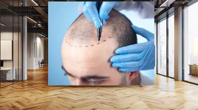 Patient suffering from hair loss in consultation with a doctor. Doctor using skin marker Wall mural