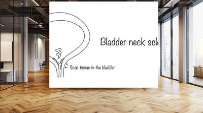 Bladder neck sclerosis Wall mural