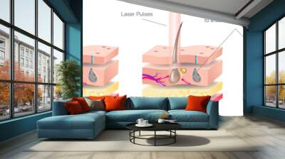 Laser hair removal is a procedure that uses a laser, or a concentrated beam of light on the skin to get rid of hair in the body vector illustration. Skin layers and how laser affects the body hair. Wall mural