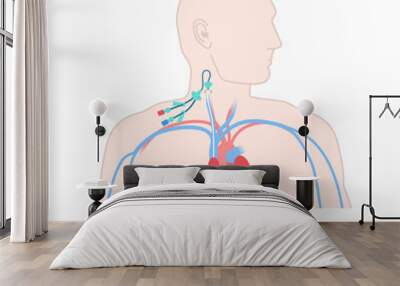 Central venous catheter placed in the jugular vein. Man with CVC access device. Internal jugular venous IJV cannulation procedure. Medical vector illustration. Wall mural