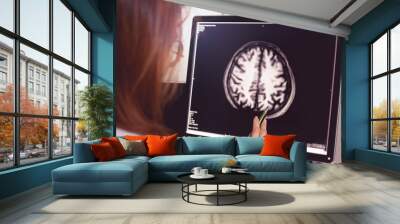 MRI brain of Dementia patient with left parietal atrophy asymmetry Wall mural