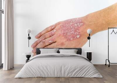 psoriasis on the hand isolated on white Wall mural