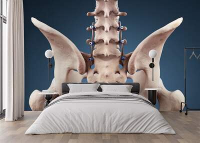 Posterior Lumbar Fusion with Pedicle Screws and Rods Wall mural