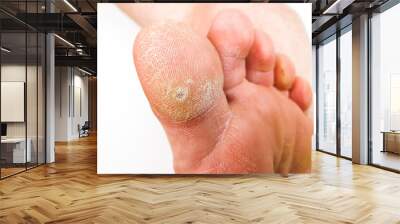 A wart on my toe. HPV plantar wart. Wall mural