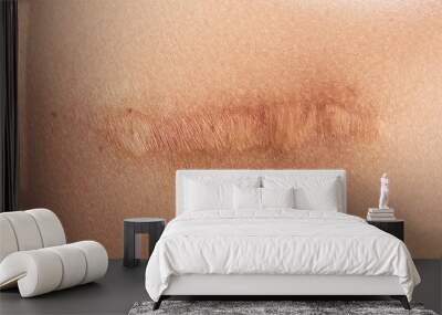 Female shoulder with a scar after surgery Wall mural