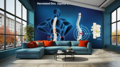 Diagram showing herniated disc in human Wall mural