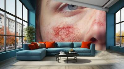 Woman with red and reddish facial rash with skin damage caused by allergy closeup. Lupus patient face needed treatment Wall mural