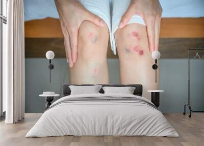 Cropped shot of woman suffering from injury, she had bruise and wound on her knees. Injured occur from falling or impact floor. Bruises happen when small blood vessels in the skin are damaged. Wall mural