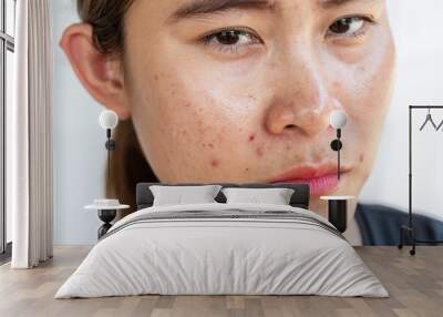 Head shot of Asian woman having problems of acne inflamed on her face. Wall mural