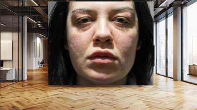 Caucasian woman with allergic reaction. Problematic face skin. Symptoms of allergic reaction. Acne problems. Close up photo. Wall mural