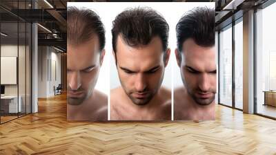 Collage of 3 photos a man with a hair loss problem before and after treatment, anti-hair loss procedures, hair transplant, on a white background, collage. Appointment with a trichologist. Wall mural