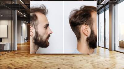 Collage of two photos of a man with a beard hair loss problem before and after treatment, anti-hair loss procedures, hair transplant, on a white background, collage. Visit to a trichologist.	 Wall mural