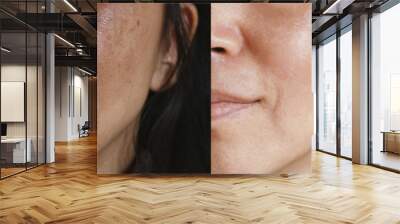 Before and after facial treatment concept. Face with melasma and brown spots and open pores. Wall mural