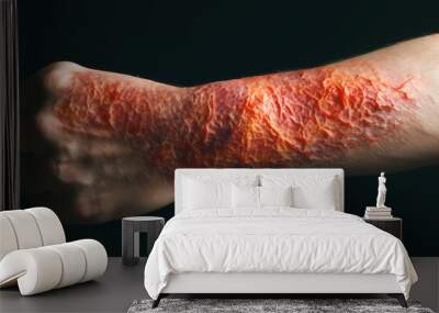 a person's forearm, with the skin showing signs of redness, itching and peeling Generative AI Wall mural