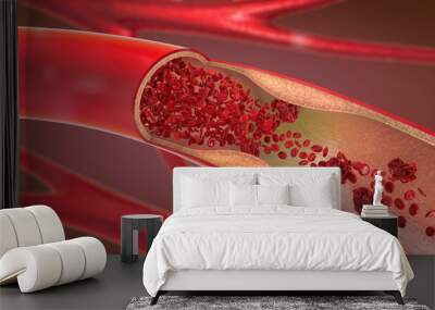 3d illustration of a constricted and narrowed artery and the blood cannot flow properly called arteriosclerosis Wall mural