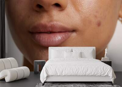 Close-up of woman face with acne Wall mural