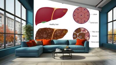 Liver histology. Normal liver and cirrhosis liver. Liver disease for medical education and science. Wall mural